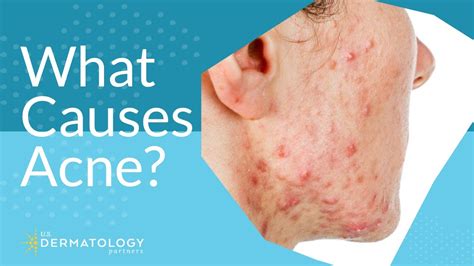 What Causes Acne Dermatologist